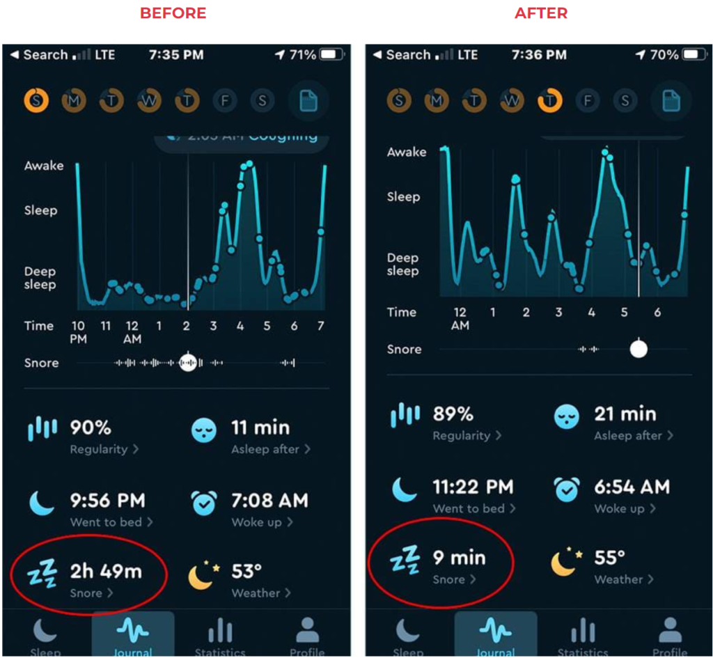 snoring before and after using Derila