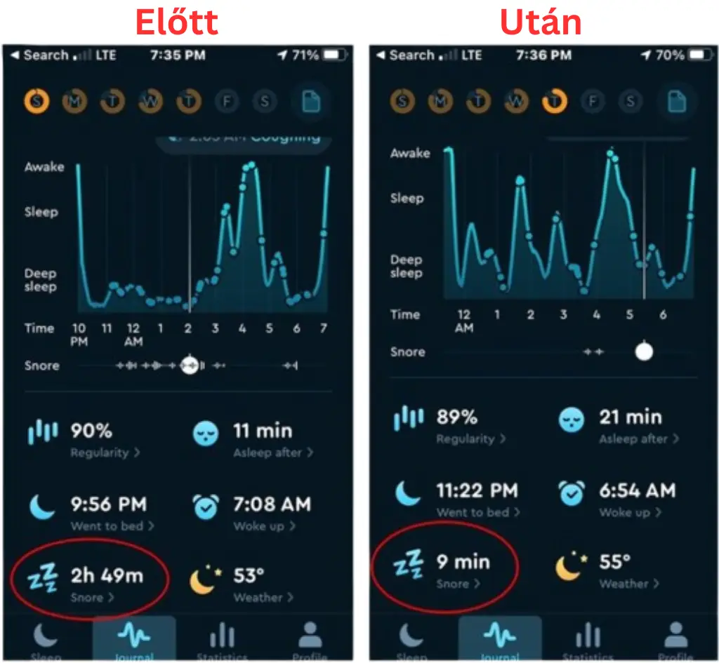 snoring before and after using Derila